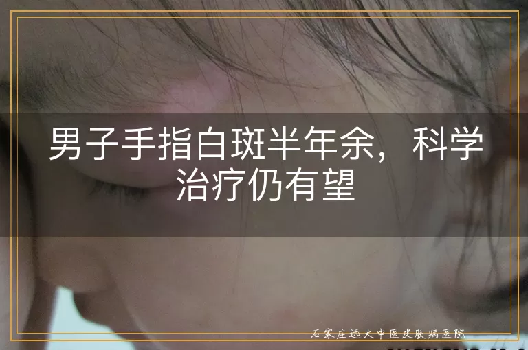 男子手指白斑半年余，科学治疗仍有望