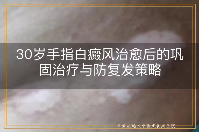 30岁手指白癜风治愈后的巩固治疗与防复发策略
