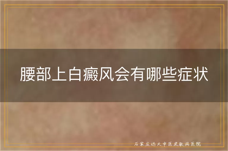 腰部上白癜风会有哪些症状