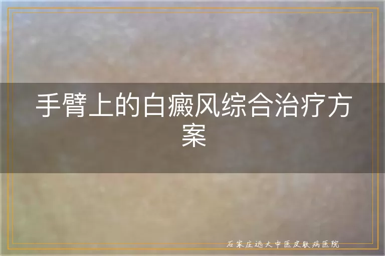 手臂上的白癜风综合治疗方案