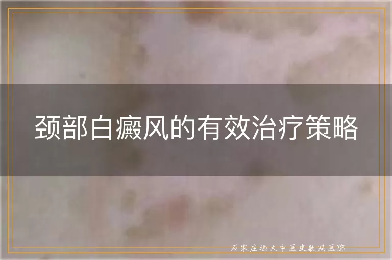 颈部白癜风的有效治疗策略