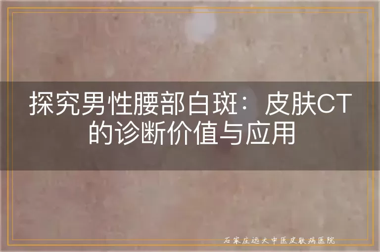 探究男性腰部白斑：皮肤CT的诊断价值与应用