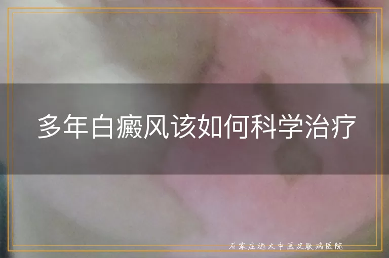 多年白癜风该如何科学治疗