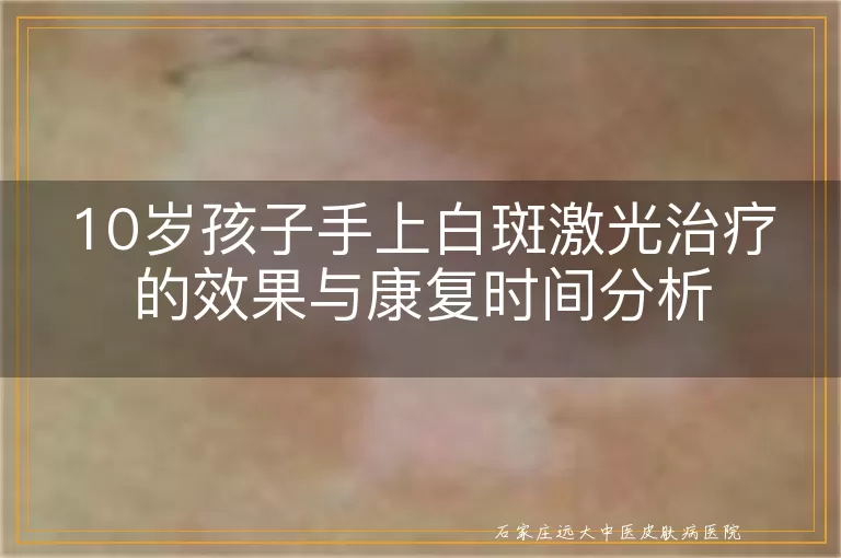 10岁孩子手上白斑激光治疗的效果与康复时间分析