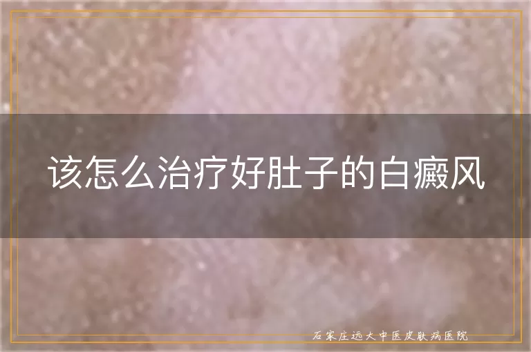 该怎么治疗好肚子的白癜风