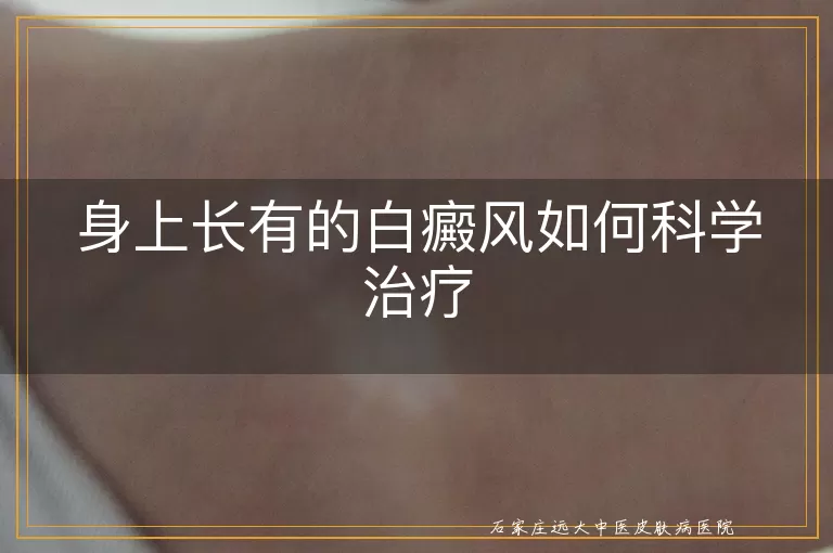 身上长有的白癜风如何科学治疗