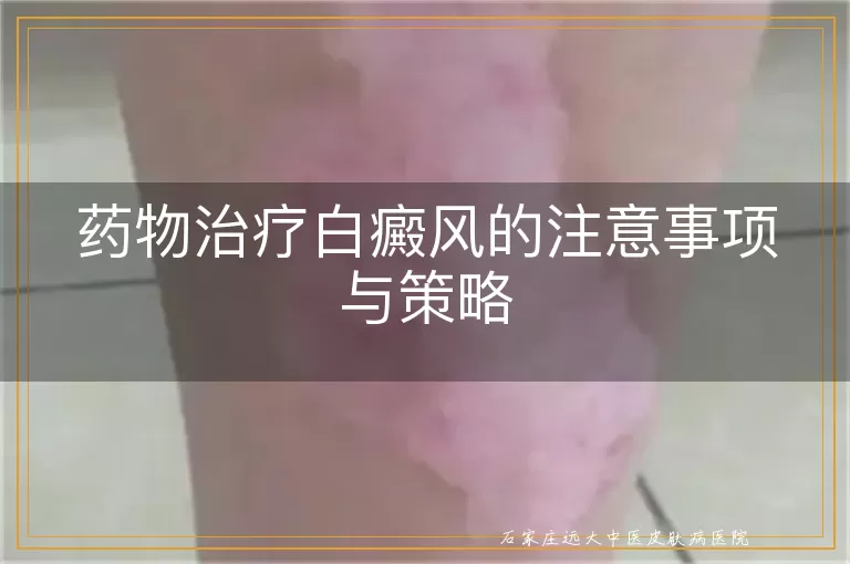 药物治疗白癜风的注意事项与策略