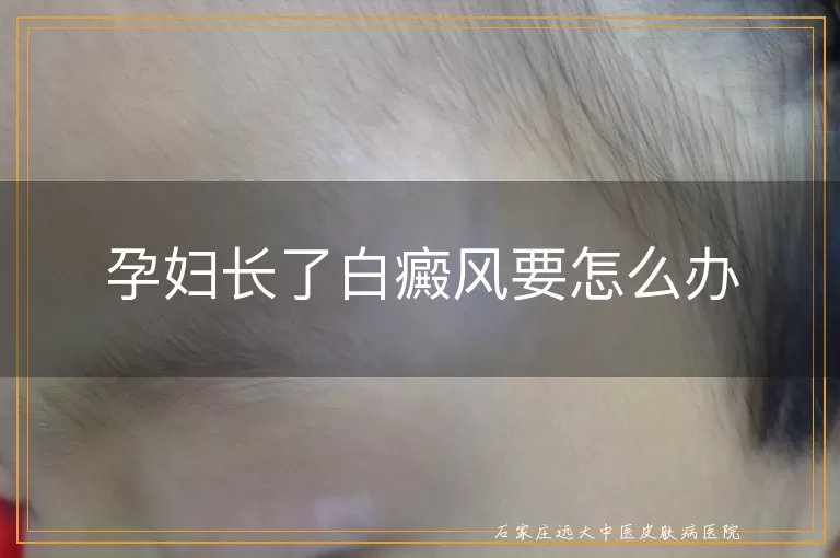 孕妇长了白癜风要怎么办