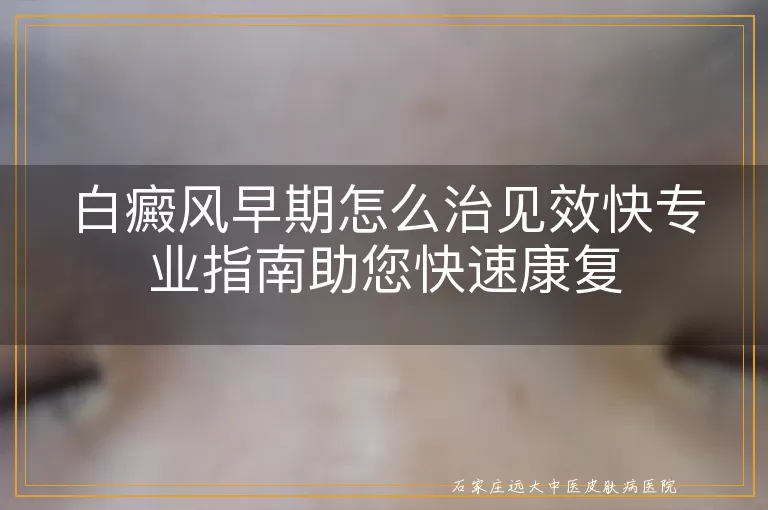 白癜风早期怎么治见效快专业指南助您快速康复