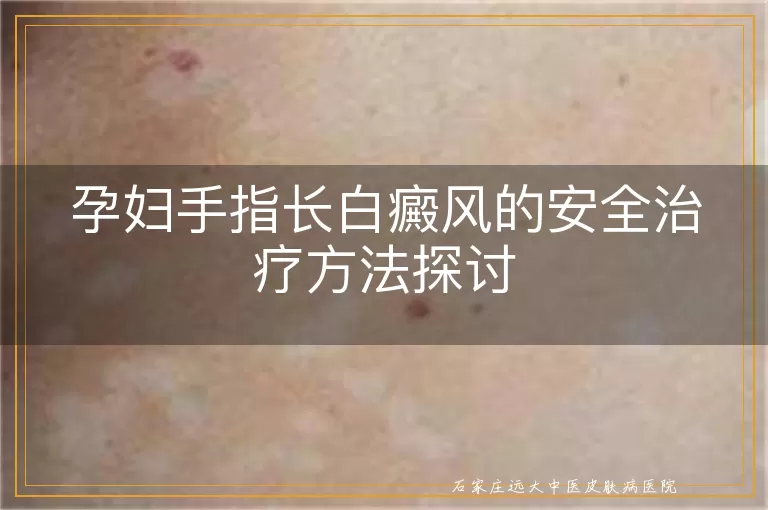 孕妇手指长白癜风的安全治疗方法探讨