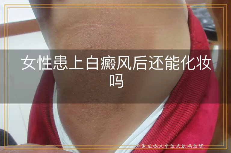 女性患上白癜风后还能化妆吗