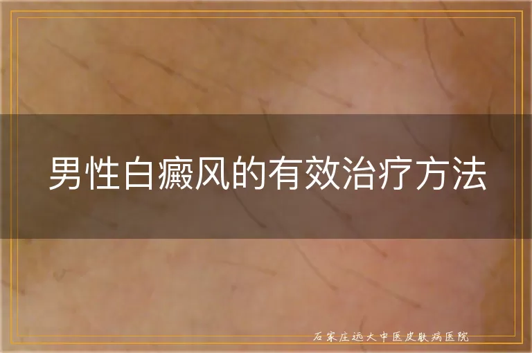男性白癜风的有效治疗方法