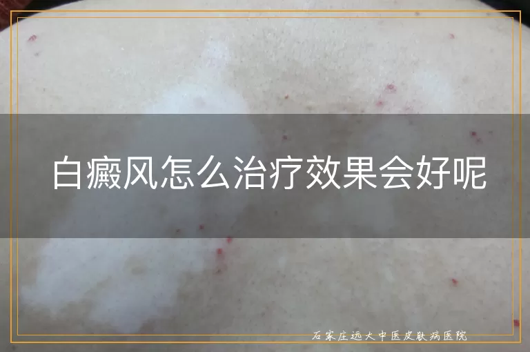 白癜风怎么治疗效果会好呢
