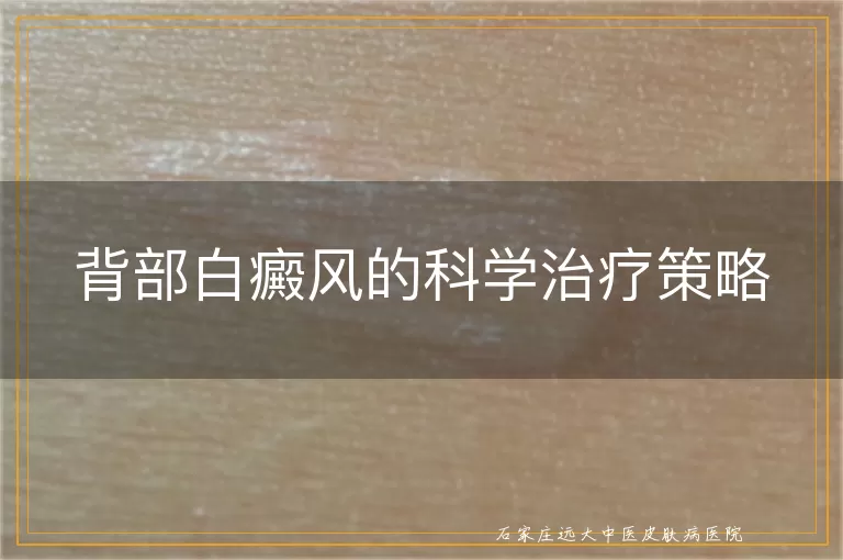 背部白癜风的科学治疗策略