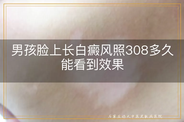 男孩脸上长白癜风照308多久能看到效果