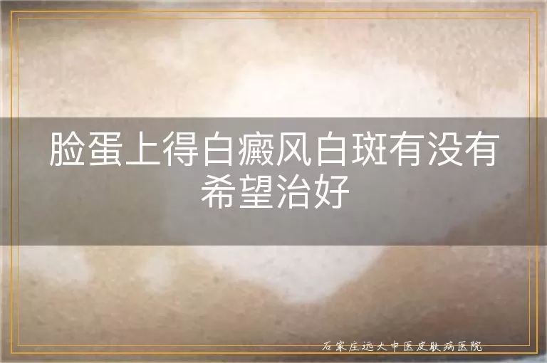 脸蛋上得白癜风白斑有没有希望治好