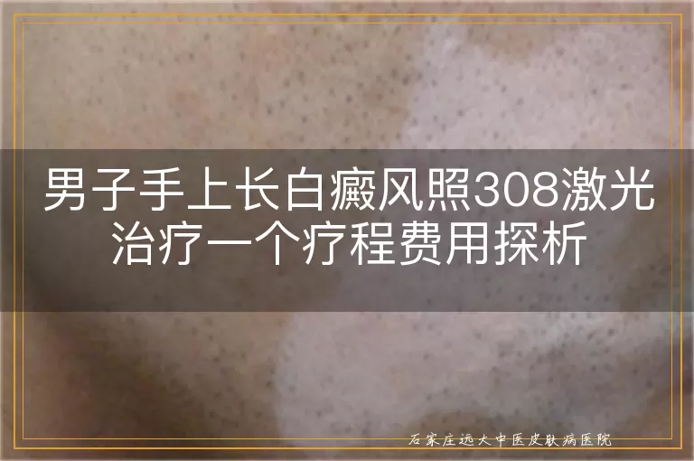 男子手上长白癜风照308激光治疗一个疗程费用探析