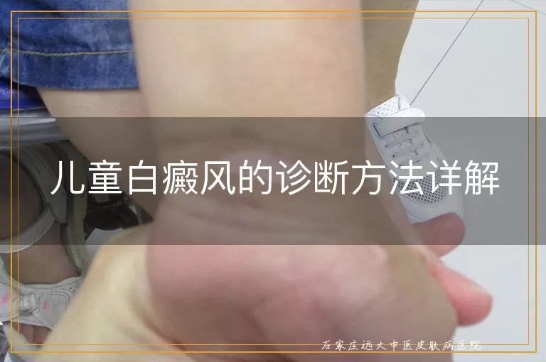 儿童白癜风的诊断方法详解