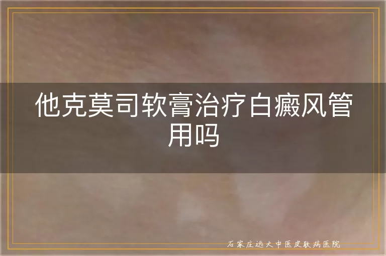他克莫司软膏治疗白癜风管用吗