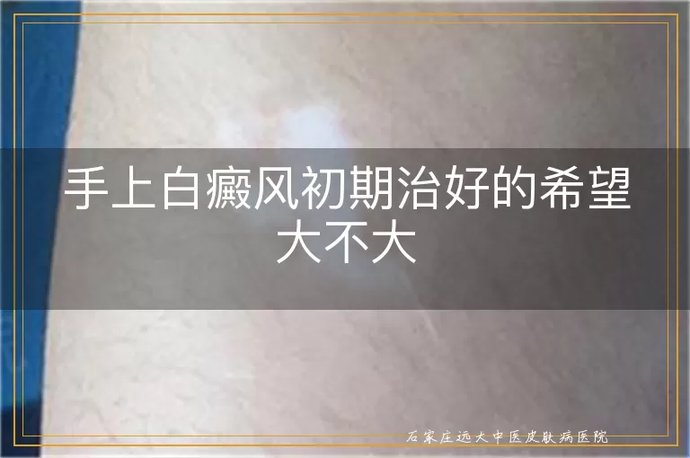 手上白癜风初期治好的希望大不大
