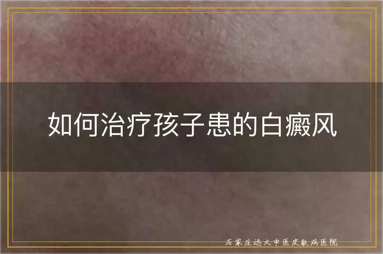 如何治疗孩子患的白癜风