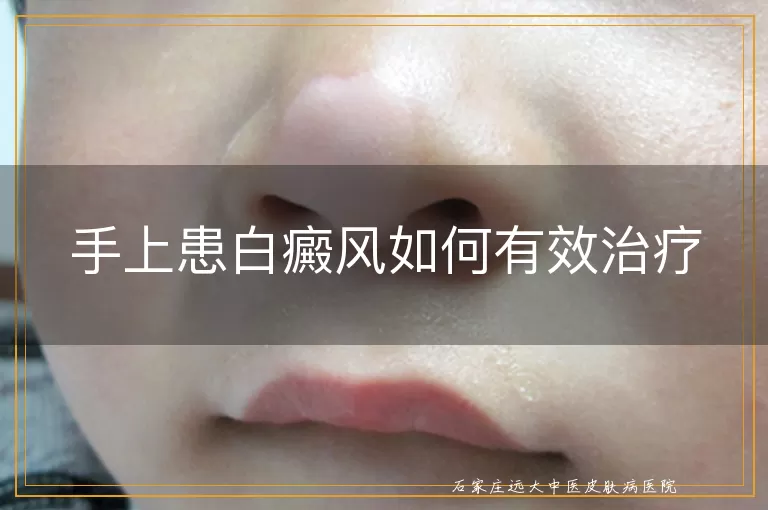 手上患白癜风如何有效治疗