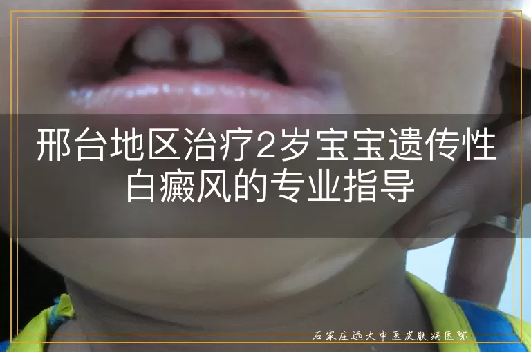 邢台地区治疗2岁宝宝遗传性白癜风的专业指导