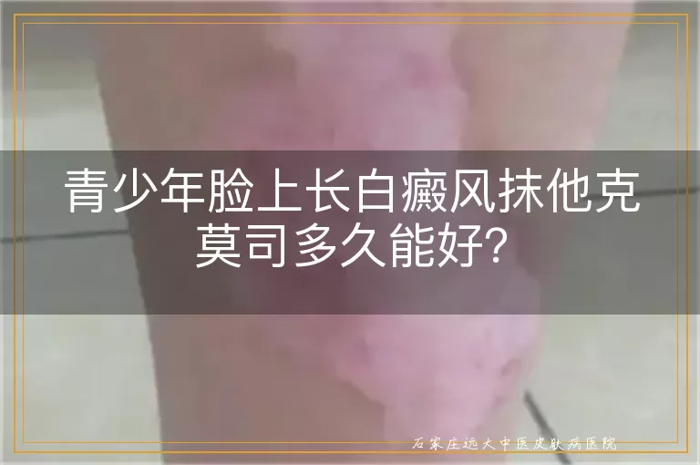 青少年脸上长白癜风抹他克莫司多久能好？