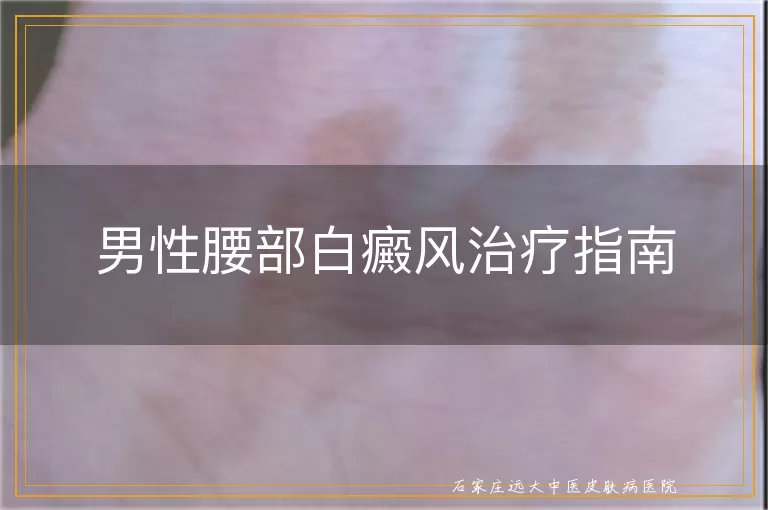 男性腰部白癜风治疗指南