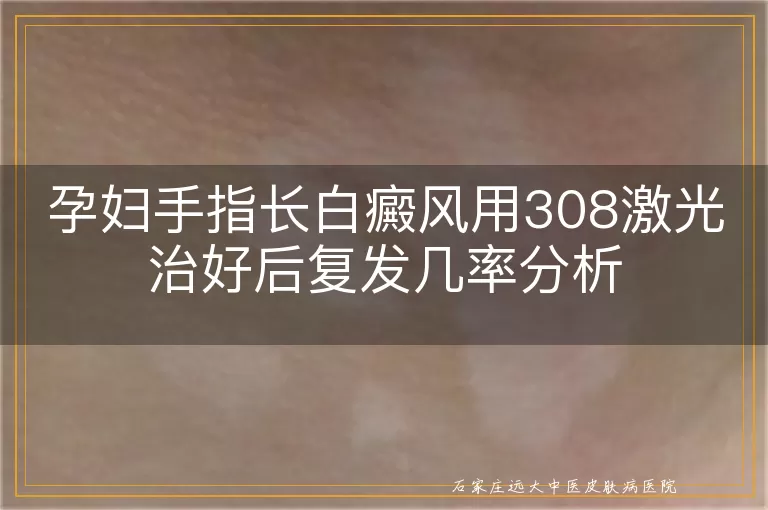 孕妇手指长白癜风用308激光治好后复发几率分析