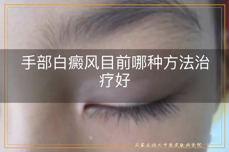 手部白癜风目前哪种方法治疗好