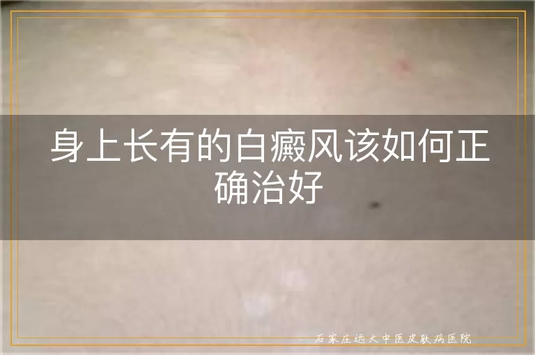 身上长有的白癜风该如何正确治好