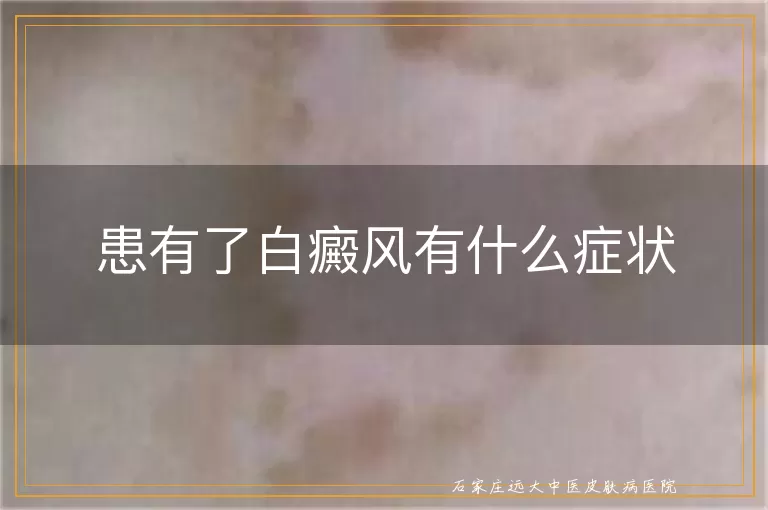 患有了白癜风有什么症状