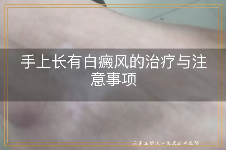 手上长有白癜风的治疗与注意事项