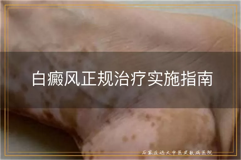 白癜风正规治疗实施指南