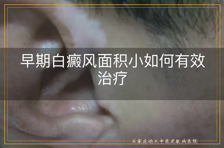 早期白癜风面积小如何有效治疗