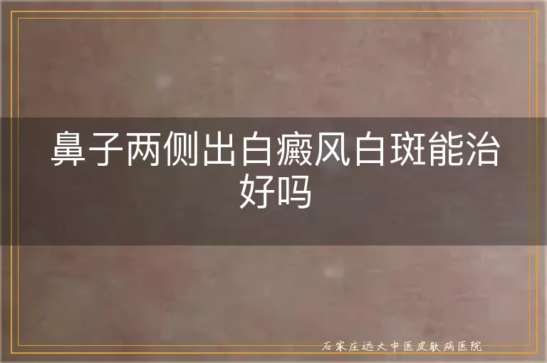 鼻子两侧出白癜风白斑能治好吗