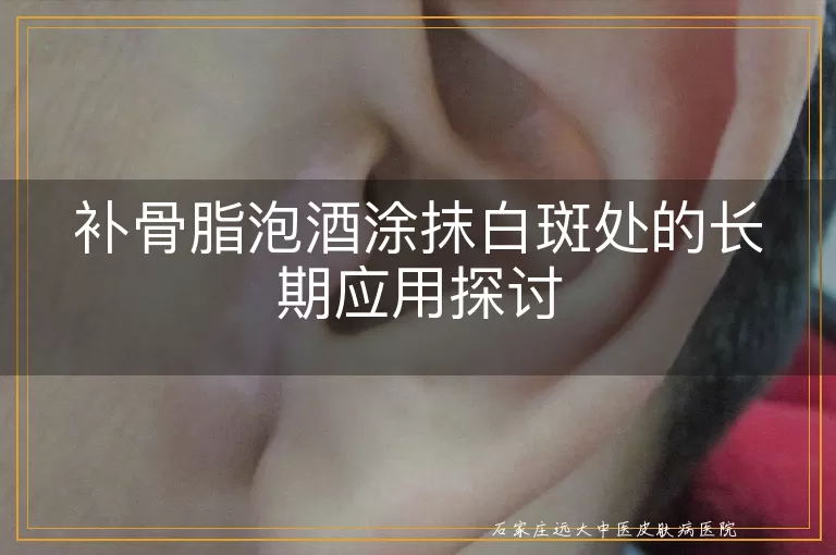 补骨脂泡酒涂抹白斑处的长期应用探讨