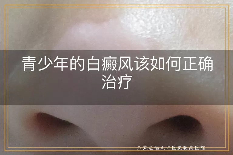 青少年的白癜风该如何正确治疗