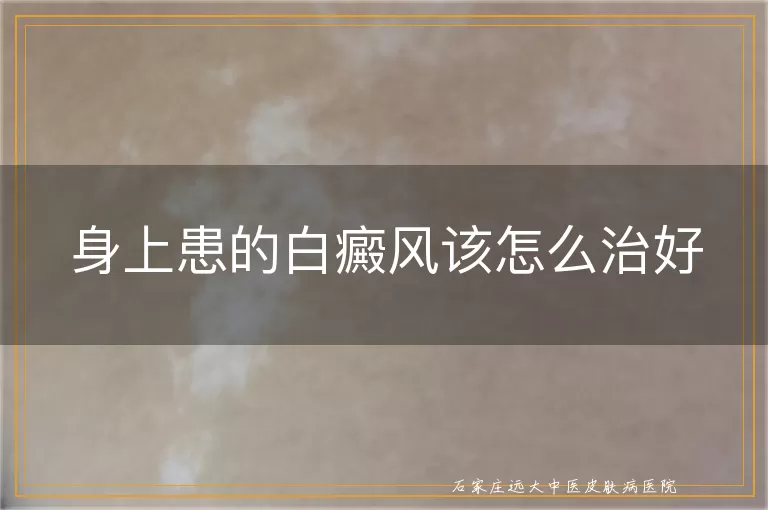 身上患的白癜风该怎么治好