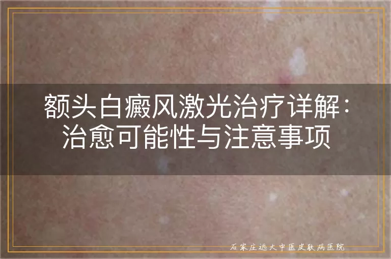 额头白癜风激光治疗详解：治愈可能性与注意事项