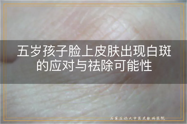 五岁孩子脸上皮肤出现白斑的应对与祛除可能性