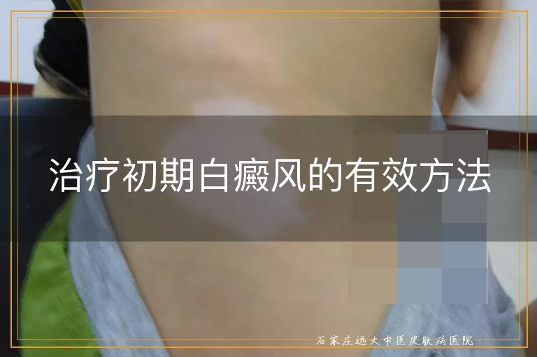 治疗初期白癜风的有效方法