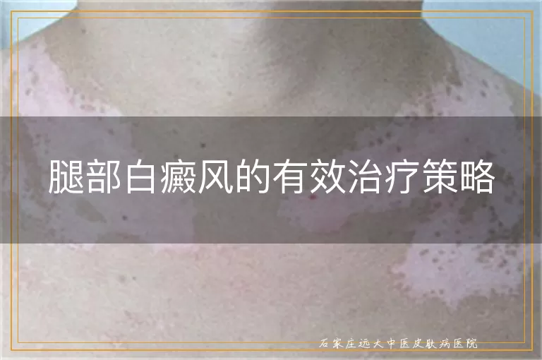 腿部白癜风的有效治疗策略