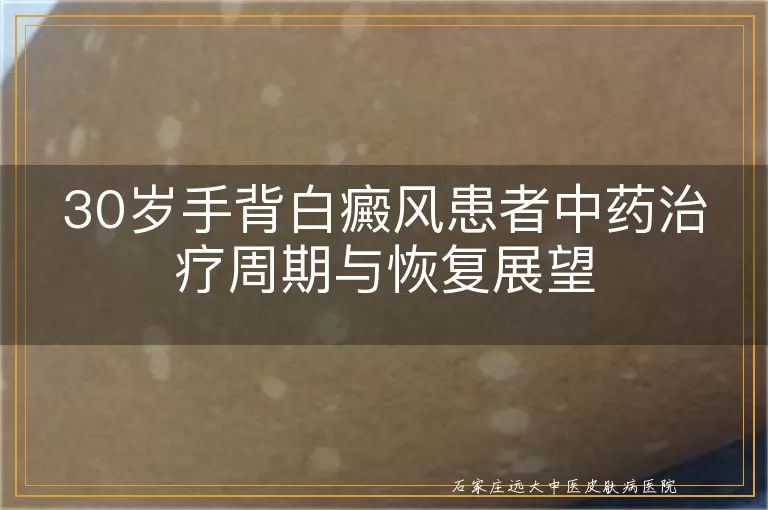 30岁手背白癜风患者中药治疗周期与恢复展望