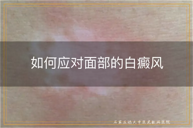 如何应对面部的白癜风