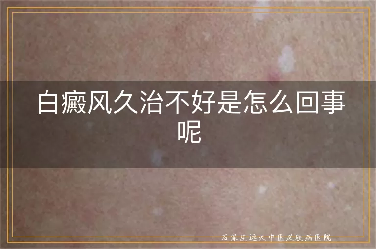 白癜风久治不好是怎么回事呢