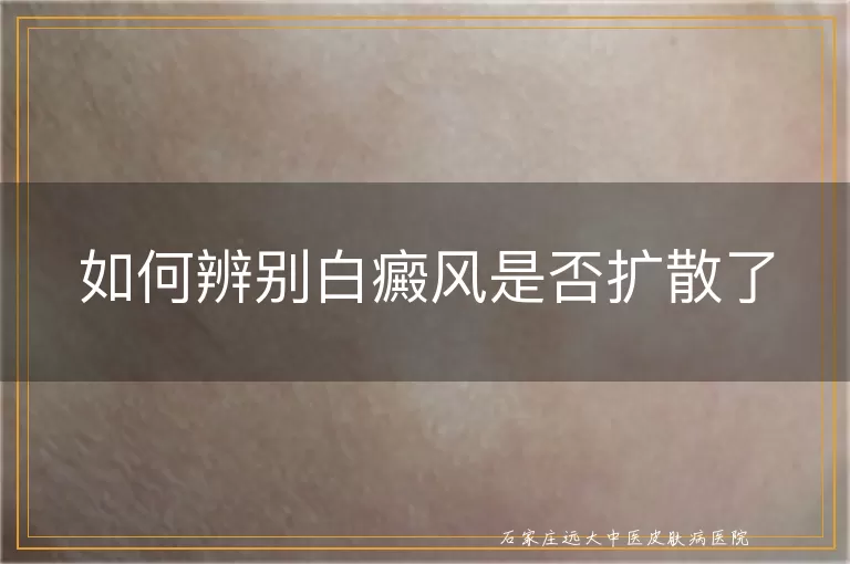 如何辨别白癜风是否扩散了