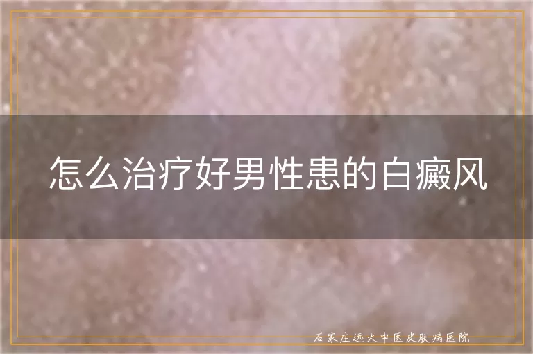 怎么治疗好男性患的白癜风