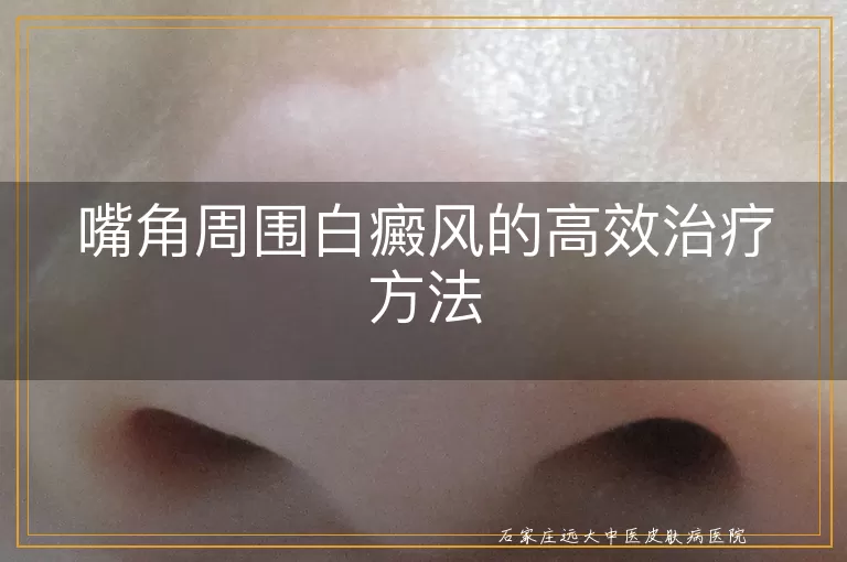 嘴角周围白癜风的高效治疗方法